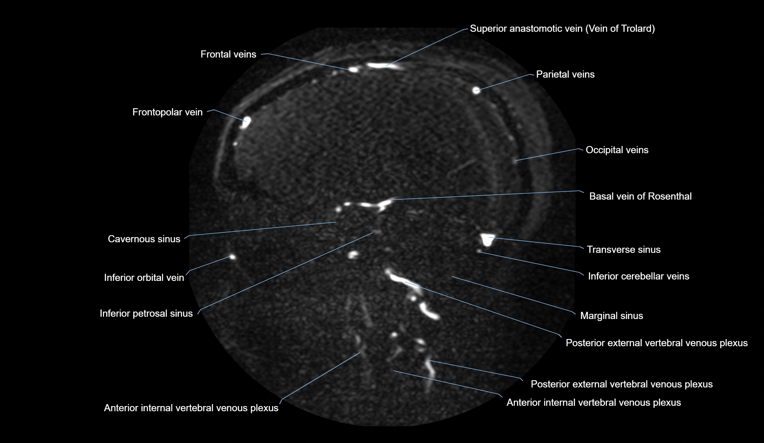 MRV brain sagittal anatomy 3T MRI labelledimages -00052.webp